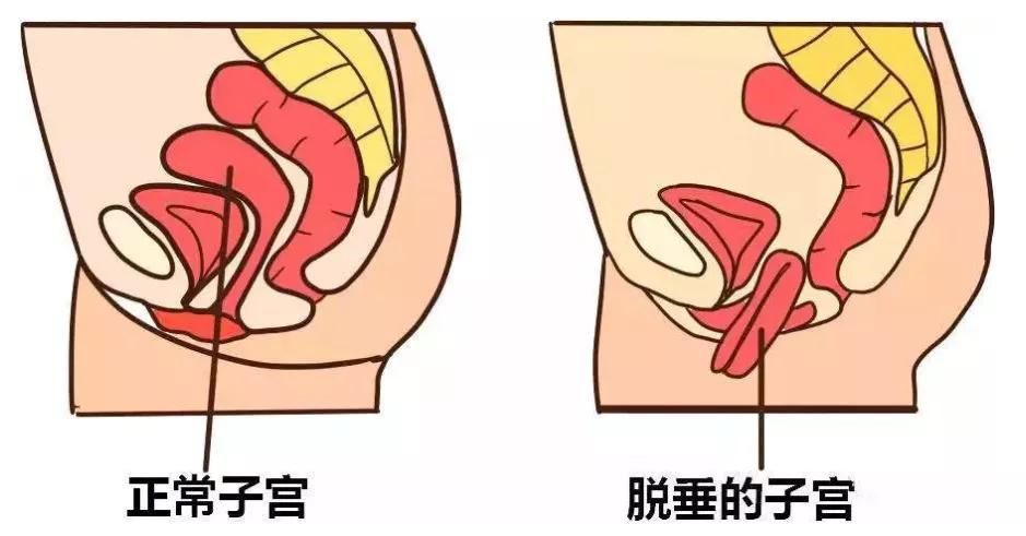 修复盆底肌，千万别错过黄金期
