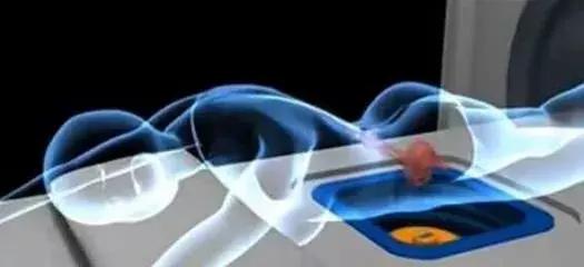 超声胃镜后的饮食注意事项,超声聚焦治疗后注意什么