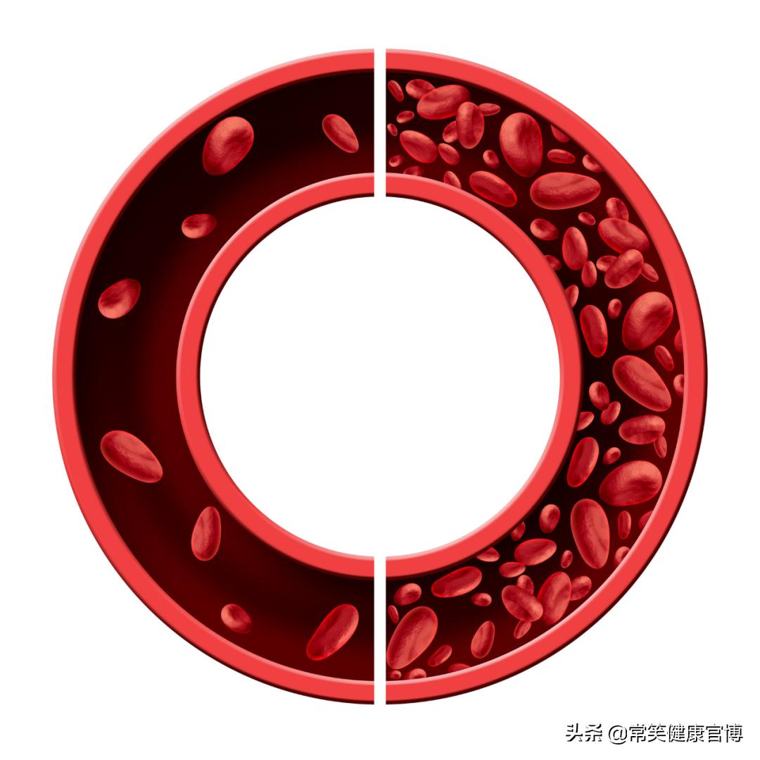 肝脏强脾弱症症状,肝脏功能减退导致脾大