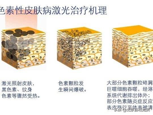 斑点橡皮擦真的能一秒祛斑吗,橡皮擦祛斑超皮秒用法