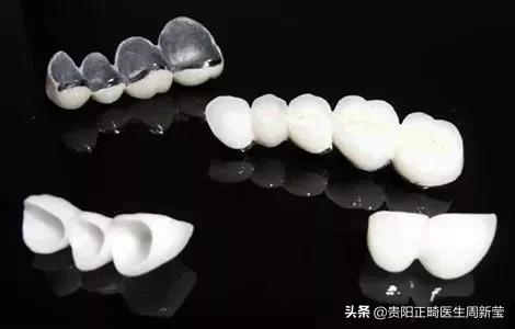 牙釉质缺损是什么样子,牙釉质缺损可以自己恢复吗