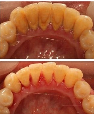 牙齿美白选什么洗牙方式,洗牙美白一般去哪里