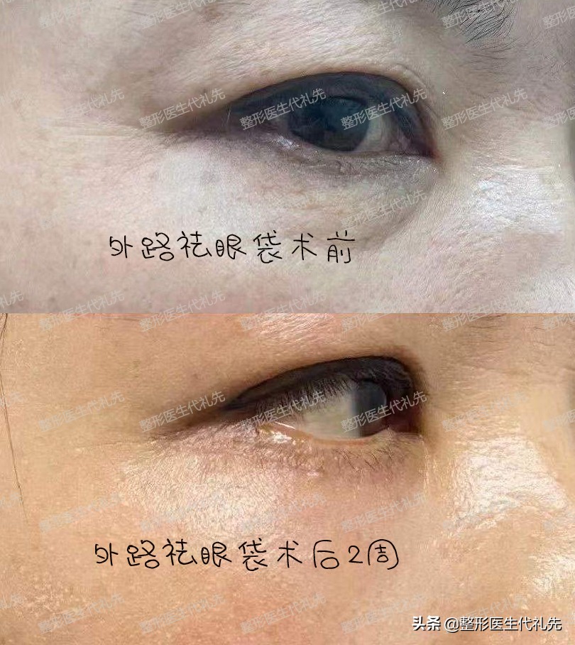 医美专家聊整形知到答案,整形医生谈去黑眼圈