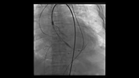 92岁老人心肺衰竭还能活多久,92岁爷爷肺不好