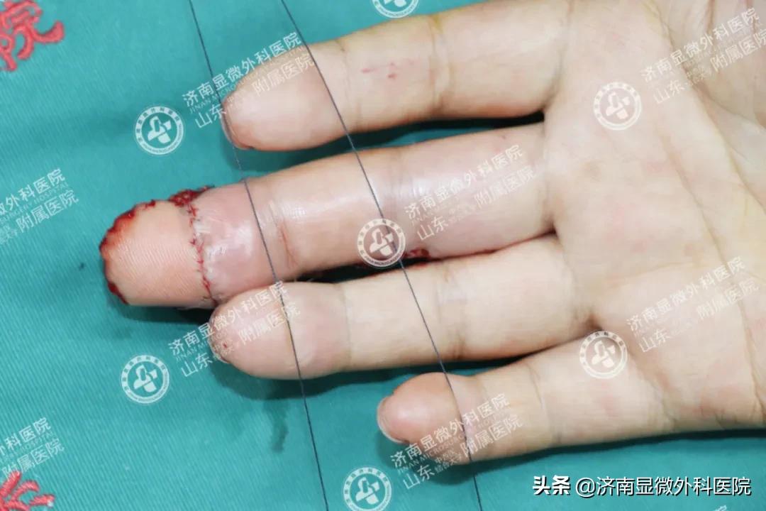 显微镜下男性复通术需要多少钱,显微镜下的手指再植