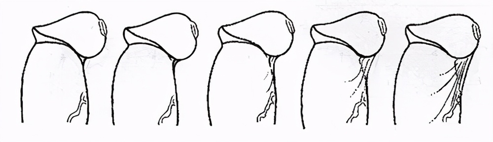 割包皮和不割包皮的区别,割包皮最好是成年前还是成年后割