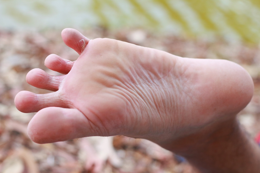 脚气的根本原因,脚气与香港脚的区别