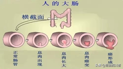 结肠癌会代代相传吗,结肠癌肝转移