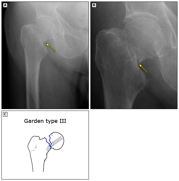 真实有效治疗骨折的方法,这几种骨折一定要注意