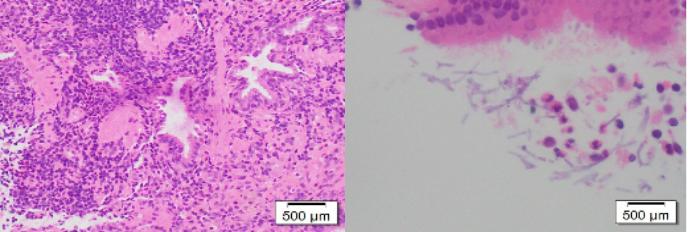 肺部陈旧病灶会变大么,肺部病灶1.2厘米严重吗
