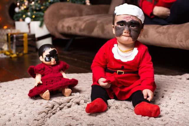 女婴脸上有胎记做了手术恢复了,女婴面部黑色胎记像蝙蝠侠面罩