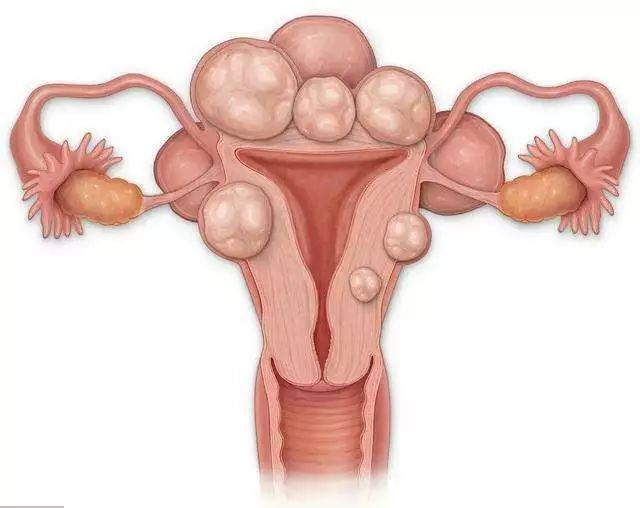 如何预防子宫肌瘤手术后复发,如何预防子宫肌瘤
