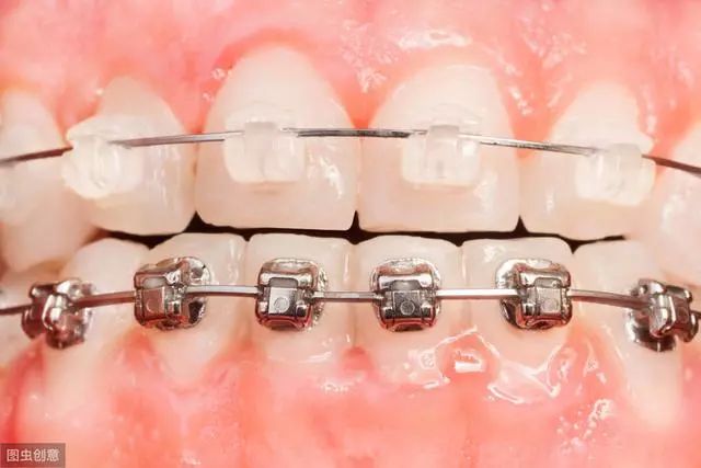 成年人做牙齿矫正合适吗,成年人有必要做牙齿矫正吗