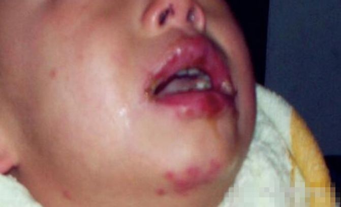 儿童化妆铅中毒,铅中毒皮肤溃烂