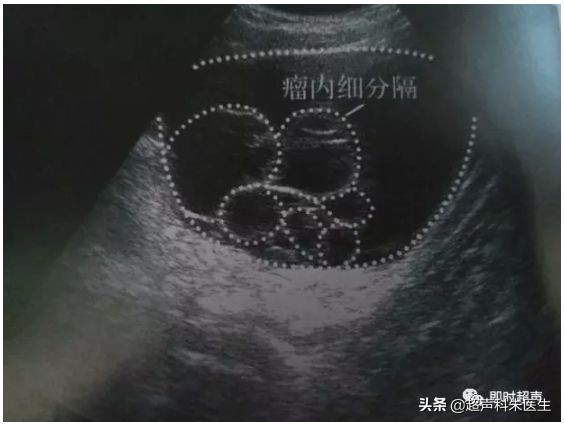 妇科超声的标准超声图,妇科超声图解