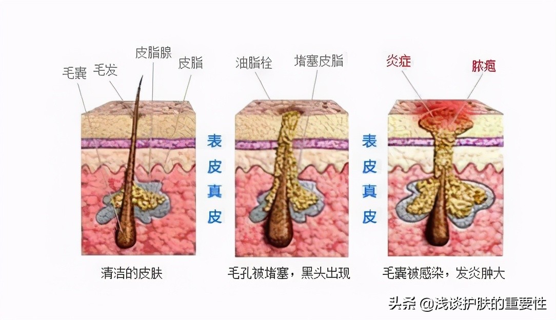 脸夏天出油冬天干燥,夏天脸出油用什么控油效果好