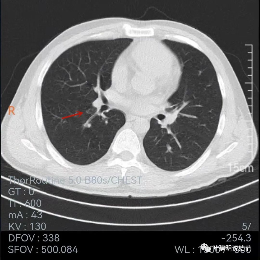 问诊分析:存在了4年的实性结节会不会是肺癌?