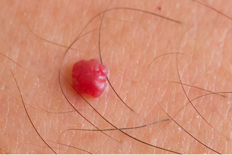 初步诊断为血管瘤还要进一步检查,诊断血管瘤