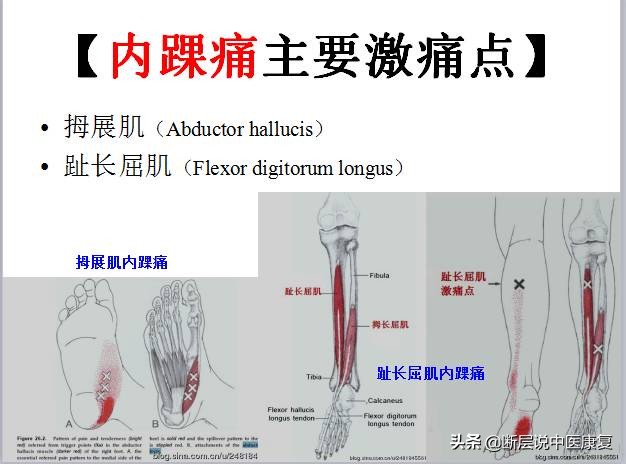 激痛点挂图,激痛点疗法笔记