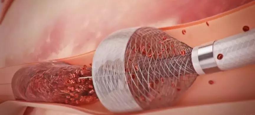 患者血栓手术实操全过程,解决血栓的最新技术