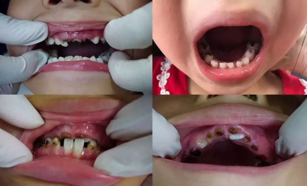 乳牙龋齿坚持刷牙能控制吗,乳牙龋坏四招教你预防