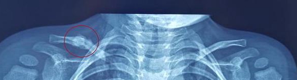 孩子高处坠落伤，脑袋没事就不用担心了？还需要注意这个部位