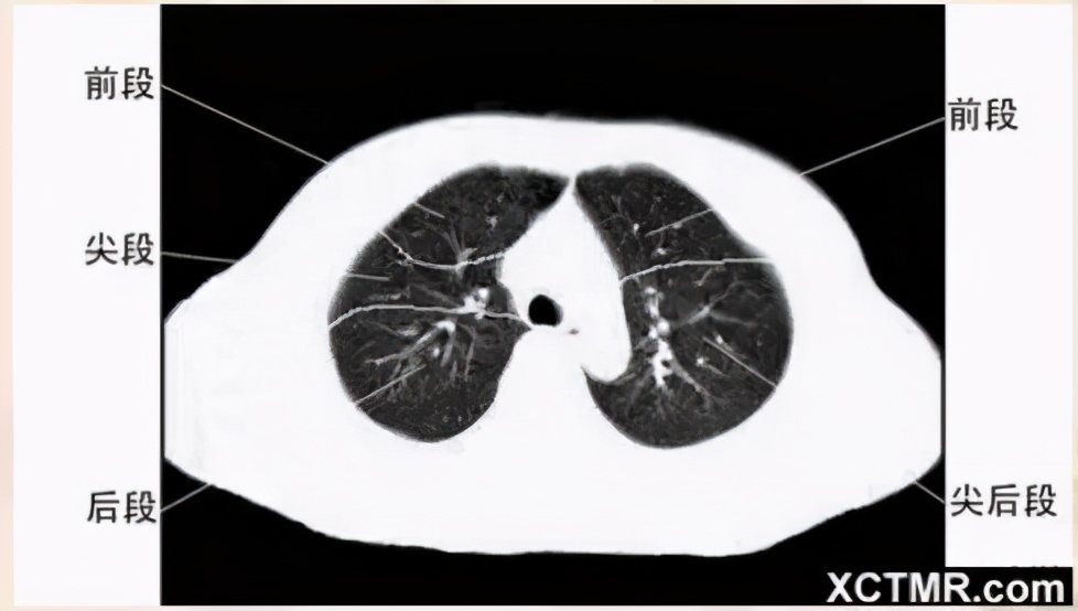 女性盆腔ct断层解剖结构图,女性盆腔脏器ct解剖