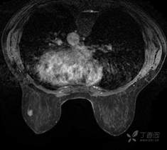 乳腺结节有消散的病例吗,一份完整的乳腺增生病例