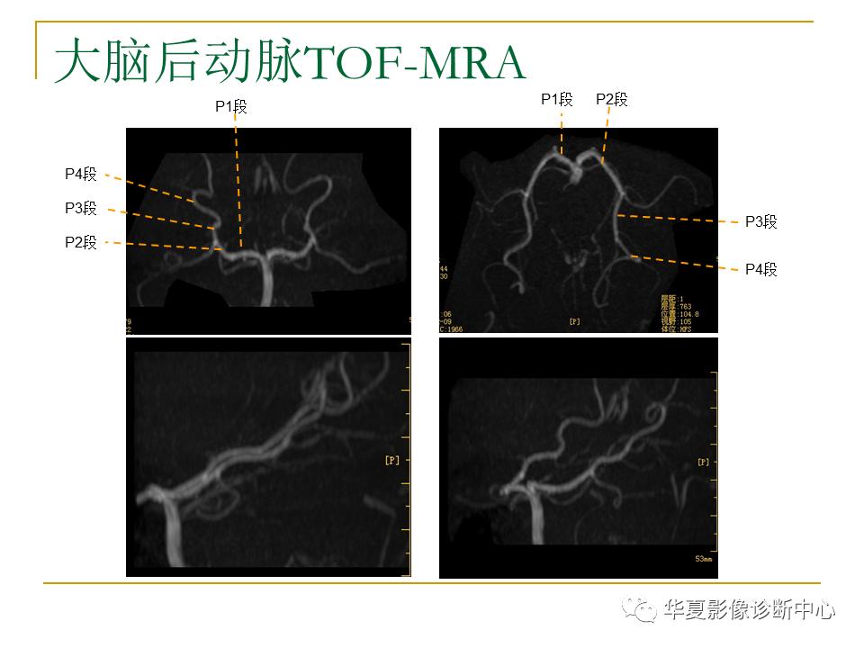 中国人脑立体定向mri应用解剖图谱,脑mri示意图