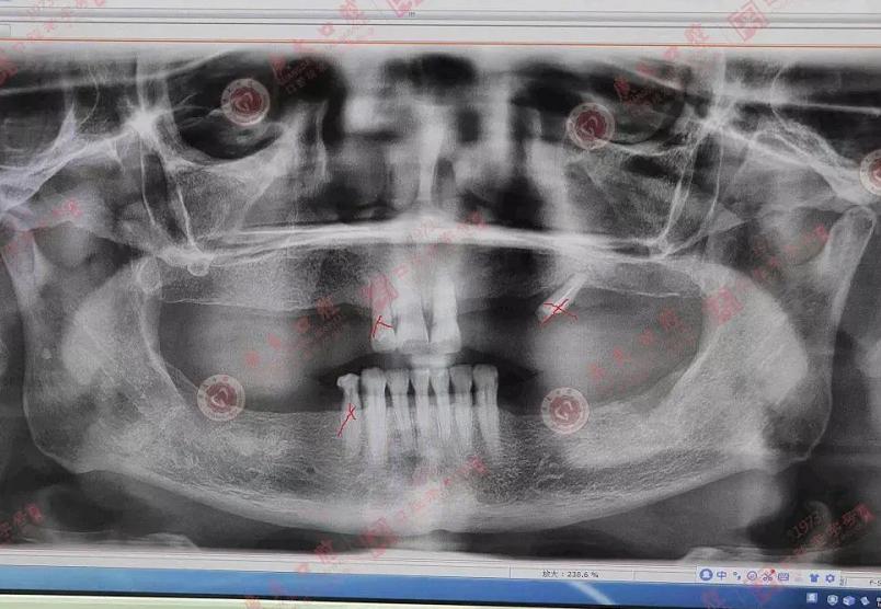 缺牙戴活动假牙40年有什么变化,上牙戴活动假牙的亲身经历