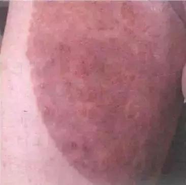 治疗真菌性皮肤病的中药方子,真菌皮肤病的书籍