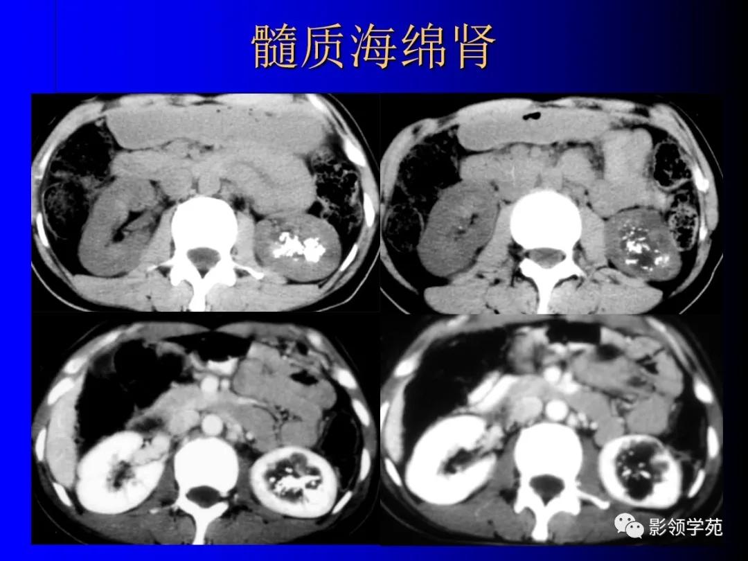 肾脏囊性肿块的影像学特点,肾脏典型病理图片及解析
