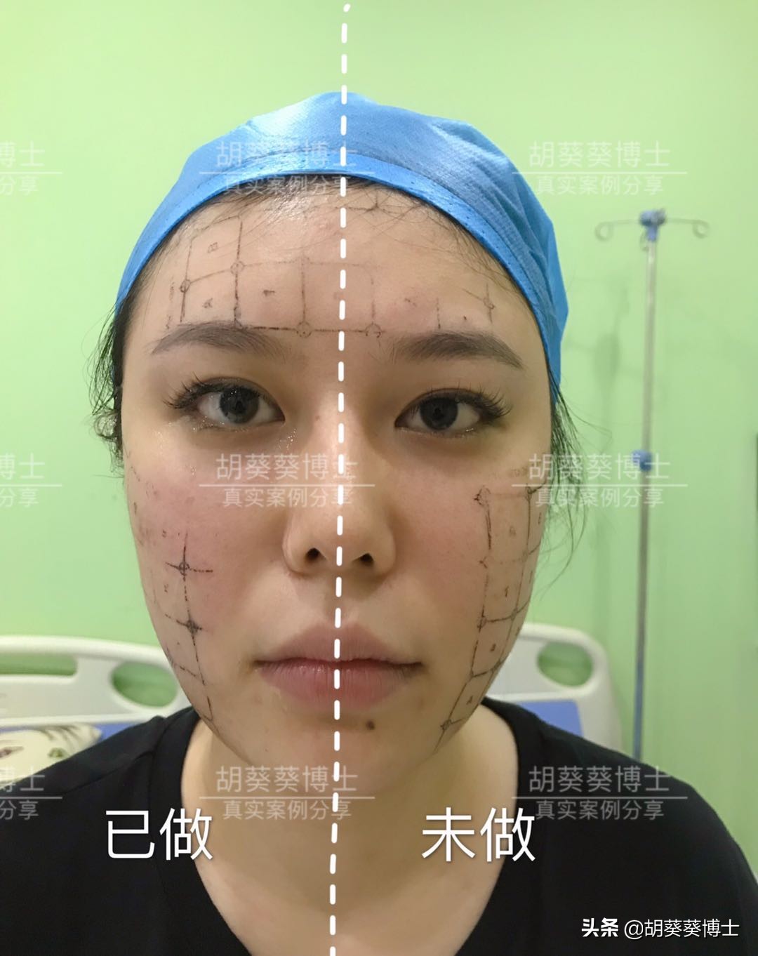 明星热玛吉推荐,明星做热玛吉