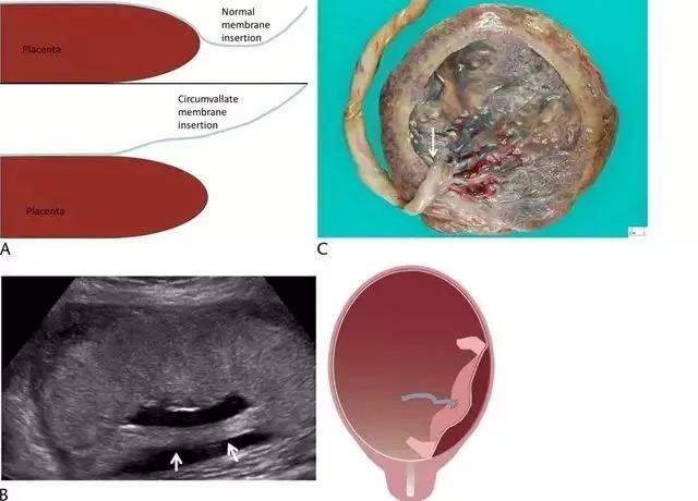 干货分享丨正常胎盘与异常胎盘的超声表现
