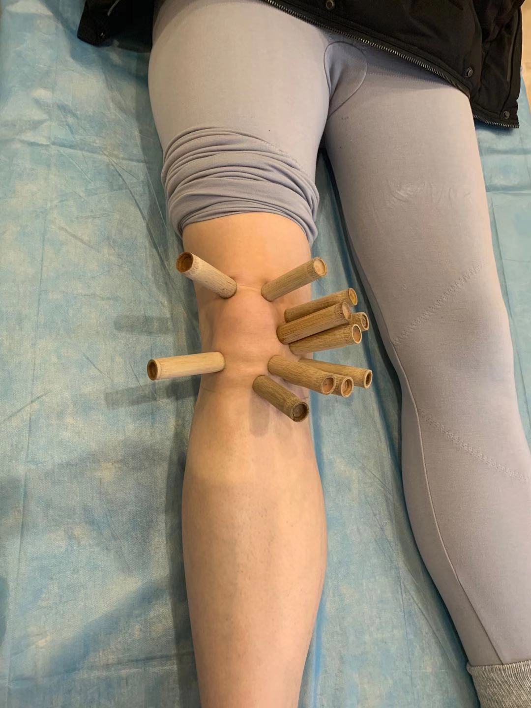 腰间盘突出没有保守治疗直接微创,腰间盘突出症不花钱自我康复疗法