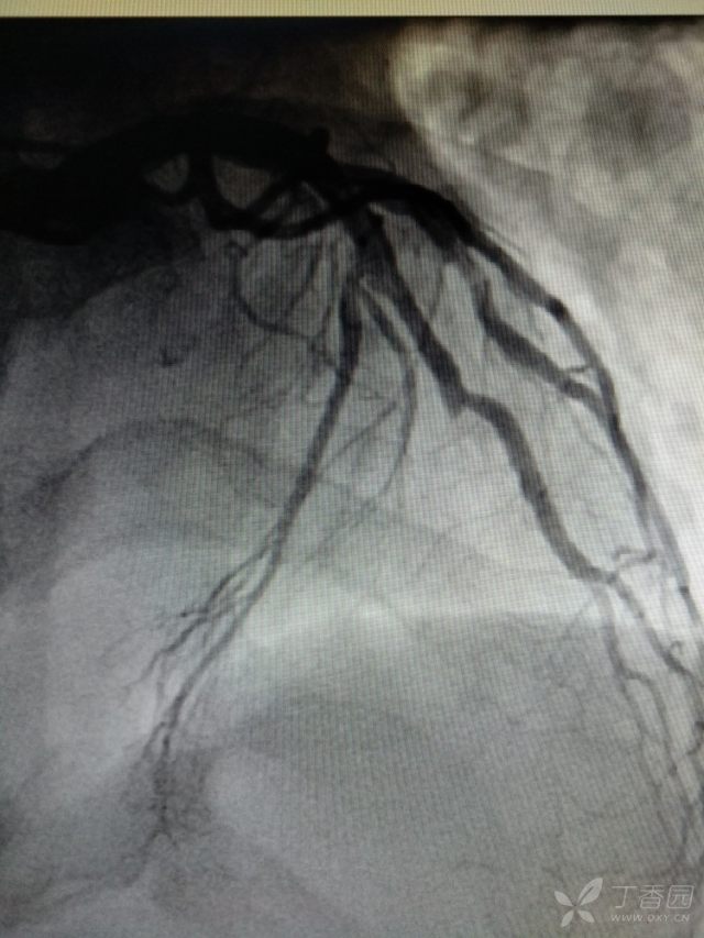 心电图心肌缺血冠脉造影正常,心脏彩超心电图冠脉造影正常