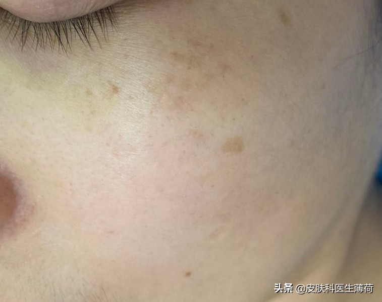 如何防止光老化氧化,预防光老化的最佳方法