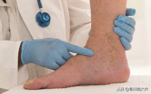 脚扭伤冰敷怎么敷,脚扭伤如何正确冰敷