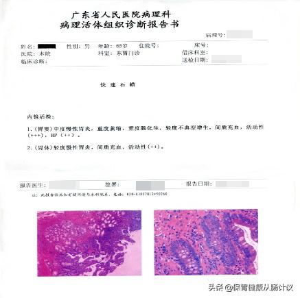 萎缩性胃炎你需要知道的5个点,萎缩性胃炎很吓人看完你就懂了