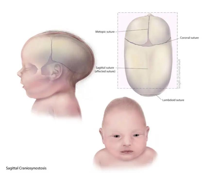 宝宝囟门小还要不要补d3,囟门末闭补维生素d还是d3
