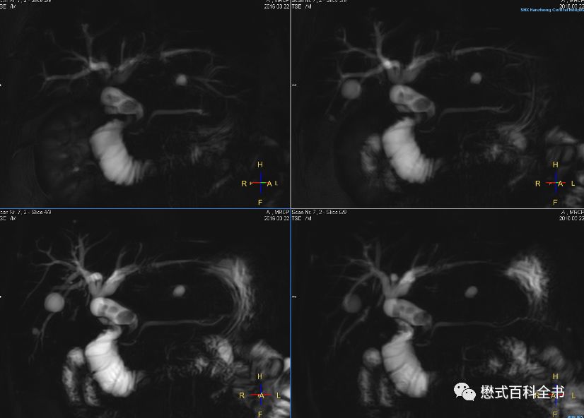 开展mrcp技术,mrcp检查操作流程