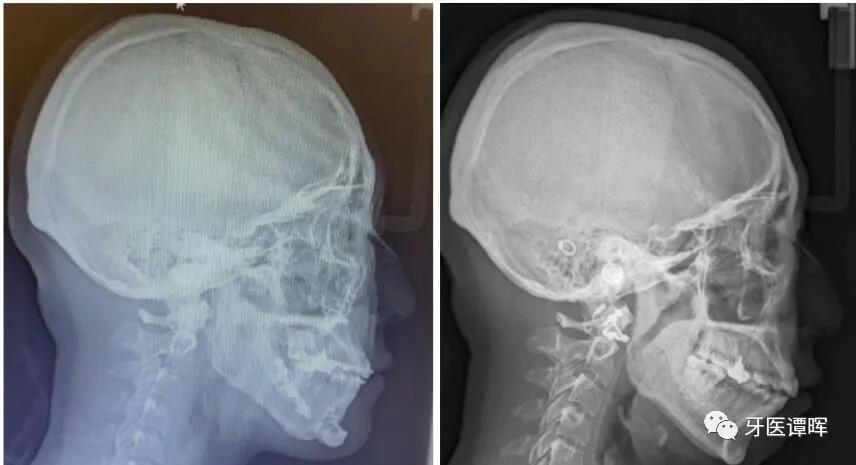 超详细的牙齿矫正过程,重叠牙齿矫正变化过程