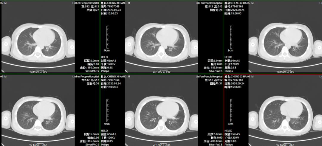 小孩支气管镜取异物技术成熟吗,小儿内镜异物取出术