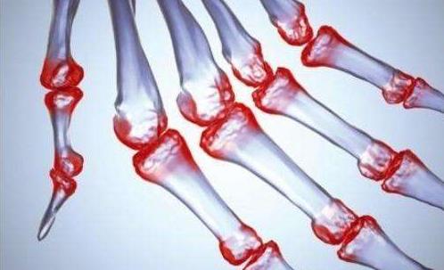 治疗风湿骨病的三大难题,风湿最怕的三种克星