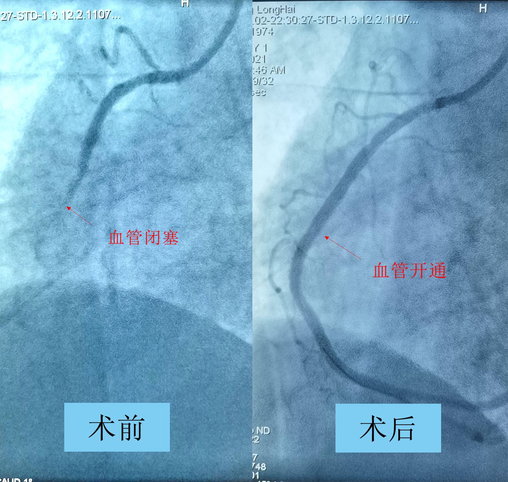 突发胸两侧处疼,突发胸疼痛是什么病
