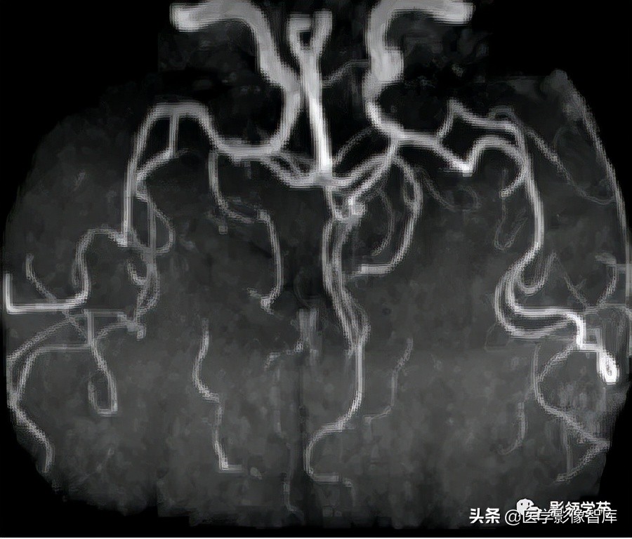 鞍区肿瘤做什么检查得出来,鞍区肿瘤的影像学鉴别