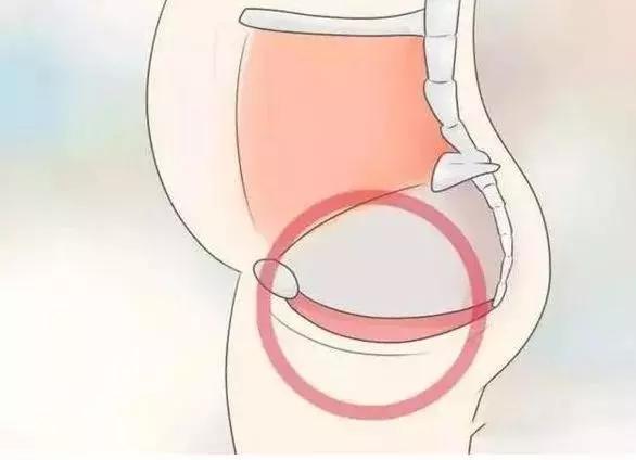 ella谈产后尿失禁,ella漏尿手术