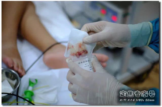 肠道息肉嘴唇黑斑,嘴唇上有黑点是肠道息肉吗