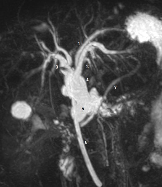 胆囊变异解剖图,胆道血供解剖