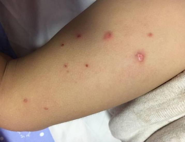 婴儿湿疹哺乳妈妈应少吃什么,湿疹可以少吃一点葱吗